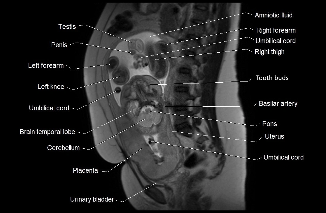 MRI fetal anatomy sagittal image 17.webp